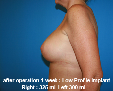 plastic-surgery-breast-augmentation